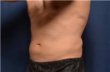 Nonsurgical Fat Reduction After Photo by Brian Hass, MD; Palm Beach Gardens, FL - Case 43011