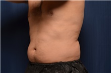 Nonsurgical Fat Reduction Before Photo by Brian Hass, MD; Palm Beach Gardens, FL - Case 43011