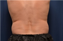 Nonsurgical Fat Reduction Before Photo by Brian Hass, MD; Palm Beach Gardens, FL - Case 43011