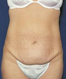 Tummy Tuck Before Photo by Melek Kayser, MD; Grosse Pointe, MI - Case 4515