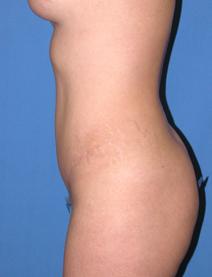 Tummy Tuck After Photo by Melek Kayser, MD; Grosse Pointe, MI - Case 4515