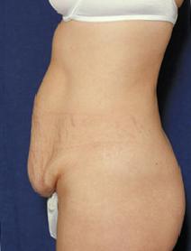 Tummy Tuck Before Photo by Melek Kayser, MD; Grosse Pointe, MI - Case 4515