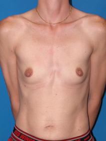 Breast Augmentation Before Photo by Melek Kayser, MD; Grosse Pointe, MI - Case 4572
