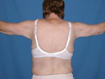 Body Contouring After Photo by Melek Kayser, MD; Grosse Pointe, MI - Case 4587