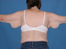 Body Contouring Before Photo by Melek Kayser, MD; Grosse Pointe, MI - Case 4587