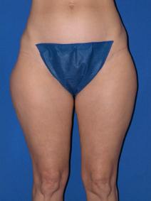Liposuction Before Photo by Melek Kayser, MD; Grosse Pointe, MI - Case 4611