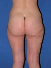 Liposuction After Photo by Melek Kayser, MD; Grosse Pointe, MI - Case 4611
