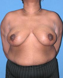 Breast Reduction After Photo by Melek Kayser, MD; Grosse Pointe, MI - Case 4696
