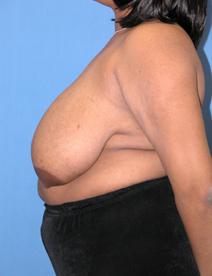 Breast Reduction Before Photo by Melek Kayser, MD; Grosse Pointe, MI - Case 4696
