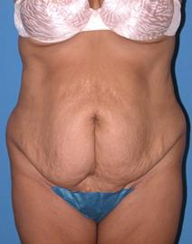 Tummy Tuck Before Photo by Melek Kayser, MD; Grosse Pointe, MI - Case 4734