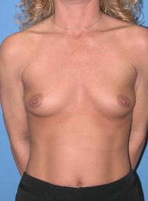 Breast Augmentation Before Photo by Melek Kayser, MD; Grosse Pointe, MI - Case 4779