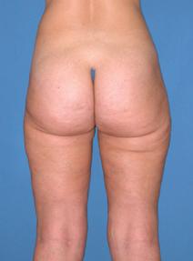 Liposuction After Photo by Melek Kayser, MD; Grosse Pointe, MI - Case 4969