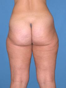 Liposuction Before Photo by Melek Kayser, MD; Grosse Pointe, MI - Case 4969