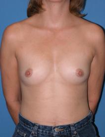 Breast Augmentation Before Photo by Melek Kayser, MD; Grosse Pointe, MI - Case 6590