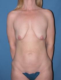 Tummy Tuck Before Photo by Melek Kayser, MD; Grosse Pointe, MI - Case 6594