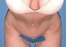 Tummy Tuck After Photo by Melek Kayser, MD; Grosse Pointe, MI - Case 6594