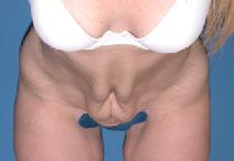 Tummy Tuck Before Photo by Melek Kayser, MD; Grosse Pointe, MI - Case 6594