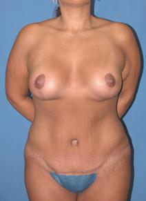 Tummy Tuck After Photo by Melek Kayser, MD; Grosse Pointe, MI - Case 6595