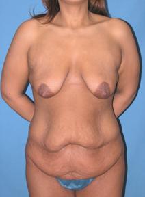 Tummy Tuck Before Photo by Melek Kayser, MD; Grosse Pointe, MI - Case 6595