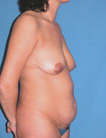 Tummy Tuck Before Photo by Melek Kayser, MD; Grosse Pointe, MI - Case 6596