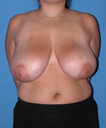 Breast Reduction Before Photo by Melek Kayser, MD; Grosse Pointe, MI - Case 6600