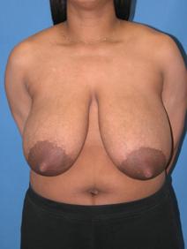 Breast Reduction Before Photo by Melek Kayser, MD; Grosse Pointe, MI - Case 6603
