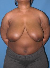 Breast Reduction Before Photo by Melek Kayser, MD; Grosse Pointe, MI - Case 6610