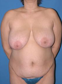 Breast Reduction Before Photo by Melek Kayser, MD; Grosse Pointe, MI - Case 6611