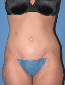 Tummy Tuck After Photo by Melek Kayser, MD; Grosse Pointe, MI - Case 6659