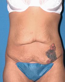 Tummy Tuck Before Photo by Melek Kayser, MD; Grosse Pointe, MI - Case 6659