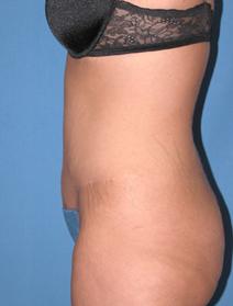 Tummy Tuck After Photo by Melek Kayser, MD; Grosse Pointe, MI - Case 6659