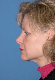 Liposuction After Photo by Melek Kayser, MD; Grosse Pointe, MI - Case 6740