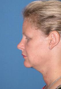 Liposuction Before Photo by Melek Kayser, MD; Grosse Pointe, MI - Case 6740