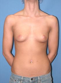 Breast Augmentation Before Photo by Melek Kayser, MD; Grosse Pointe, MI - Case 6744