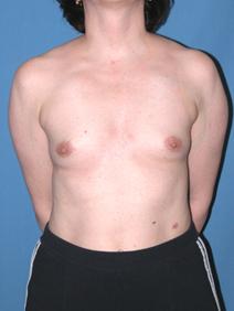 Breast Augmentation Before Photo by Melek Kayser, MD; Grosse Pointe, MI - Case 6749