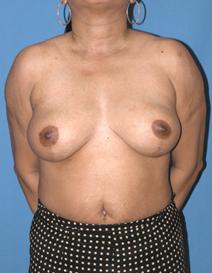Breast Reduction After Photo by Melek Kayser, MD; Grosse Pointe, MI - Case 6752