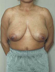 Breast Reduction Before Photo by Melek Kayser, MD; Grosse Pointe, MI - Case 6752