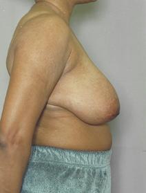 Breast Reduction Before Photo by Melek Kayser, MD; Grosse Pointe, MI - Case 6752