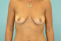Breast Augmentation Before Photo by Andrew Turk, MD; Naples, FL - Case 9054