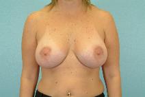 Breast Augmentation After Photo by Andrew Turk, MD; Naples, FL - Case 9061