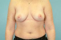Breast Augmentation Before Photo by Andrew Turk, MD; Naples, FL - Case 9112