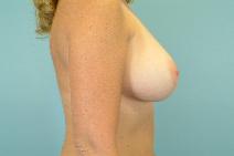 Breast Augmentation After Photo by Andrew Turk, MD; Naples, FL - Case 9112