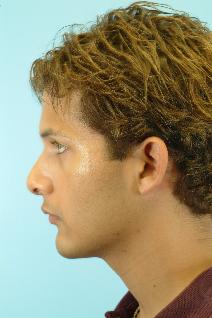 Rhinoplasty After Photo by Andrew Turk, MD; Naples, FL - Case 9268