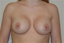 Breast Augmentation After Photo by Eric Emerson, MD; Gastonia, NC - Case 27266