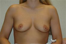 Breast Augmentation Before Photo by Eric Emerson, MD; Gastonia, NC - Case 27266