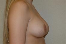 Breast Augmentation After Photo by Eric Emerson, MD; Gastonia, NC - Case 27266