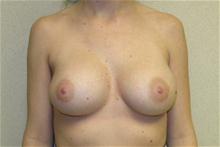 Breast Augmentation After Photo by Eric Emerson, MD; Gastonia, NC - Case 27269