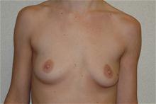 Breast Augmentation Before Photo by Eric Emerson, MD; Gastonia, NC - Case 27269