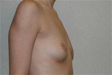 Breast Augmentation Before Photo by Eric Emerson, MD; Gastonia, NC - Case 27269