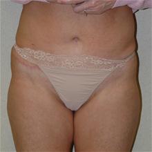 Tummy Tuck After Photo by Eric Emerson, MD; Gastonia, NC - Case 27273